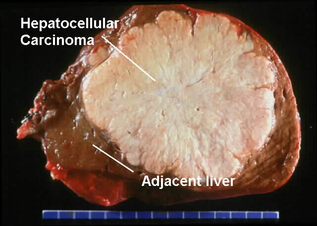 Hepatocellular Carcinoma and Hepatitis B Virus (Dr. Chau Tai-Nin)