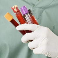 MicroRNA Blood Test May Help Diagnose Early Liver Cancer in People with Hepatitis B
