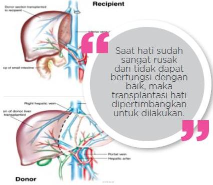 Transplantasi Hati (Dr.Tjhang Supardjo)