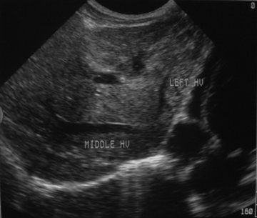 Temuan Ultrasonografi Kanker Hati Hepato Selular (Hepatoma) (Abdul Rasyid)